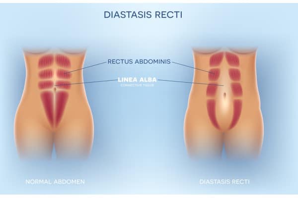 What Non-Surgical Options Are Available for Diastasis Recti Addlestone?