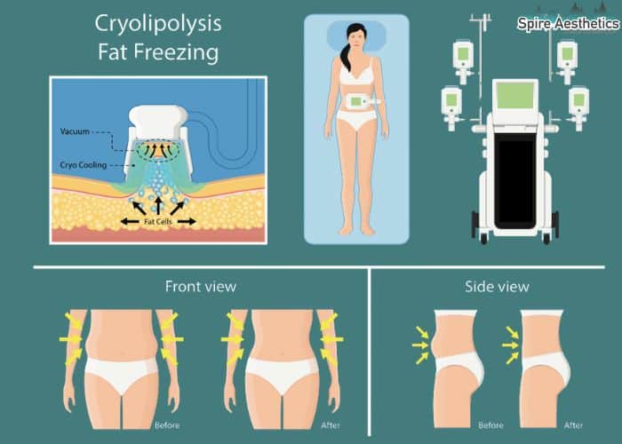 Image of diet and fat freezing combined for best results for Spire Aesthetics Addlestone