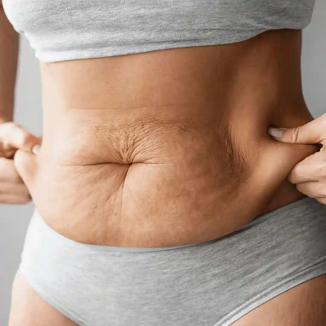 Is It Normal to Have Loose Skin After Pregnancy Addlestone?