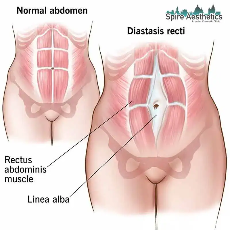 When Will My Belly Feel Normal Again Addlestone?