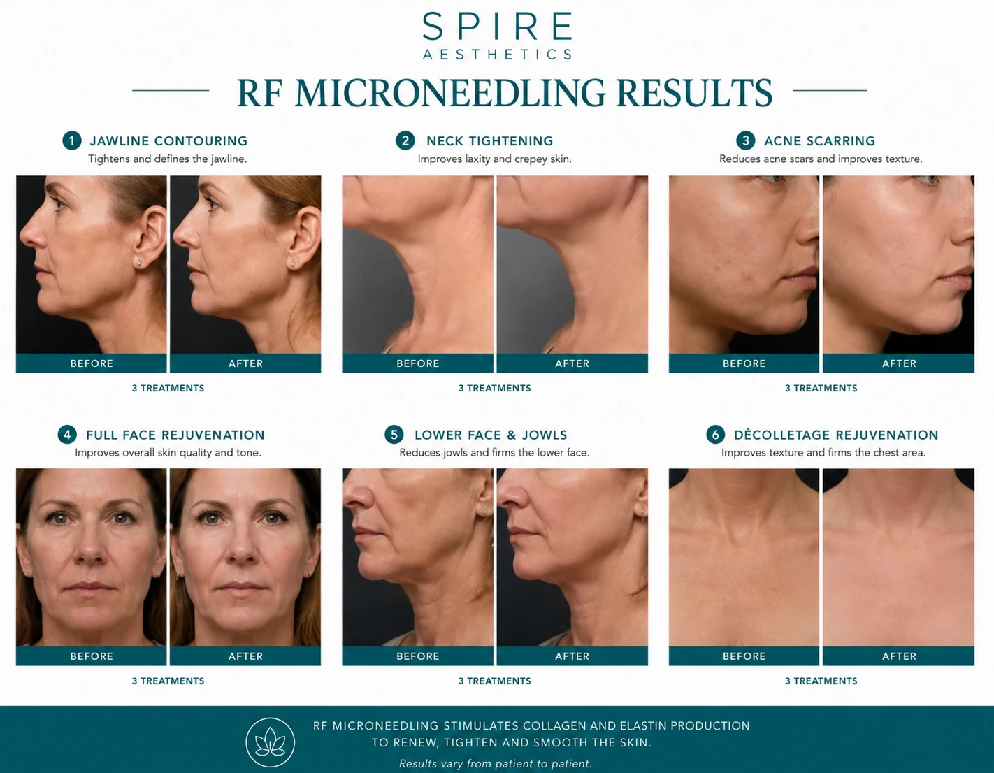 RF Microneedling Skin tightening Addlestone results
