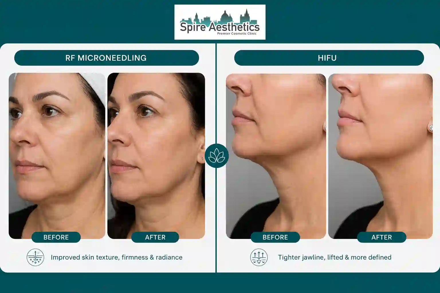 Can RF Microneedling and HIFU Be Combined Addlestone?