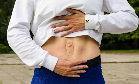 When Could Diastasis Recti Be the Missing Piece of the Puzzle Addlestone?