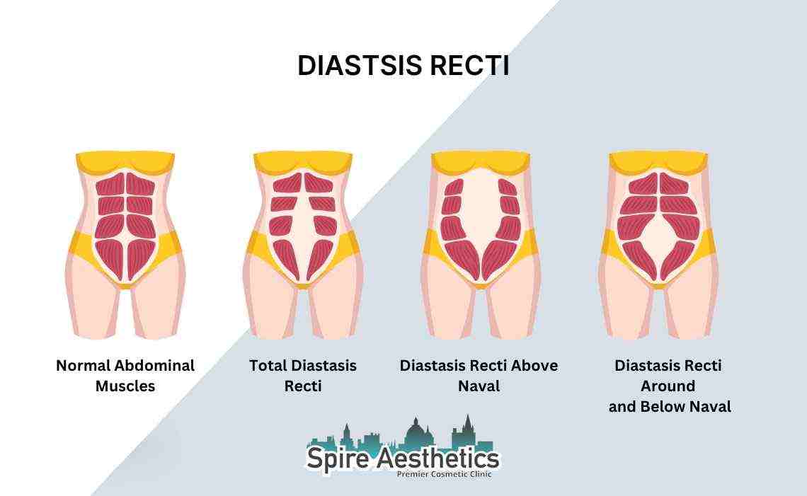 Is Non-Surgical Diastasis Recti Treatment Right for You? Common Concerns Answered Addlestone